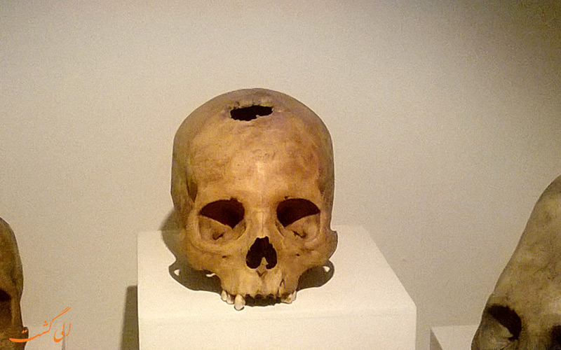 نمونه ای از سوراخ کردن جمجمه