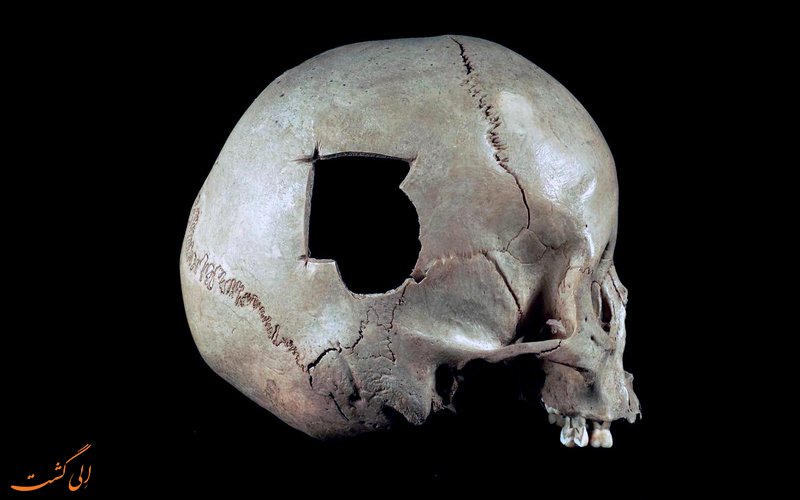 جمجمه ای سوراخ شده جمجمه ای سوراخ شده